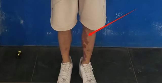 全身照腿部伤痕惊心更多受害家属发声爱游戏平台营救神速！泰方公布星星(图4)